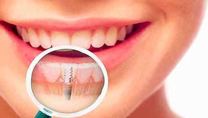 Имплантация зубов: виды анестезии и показания
