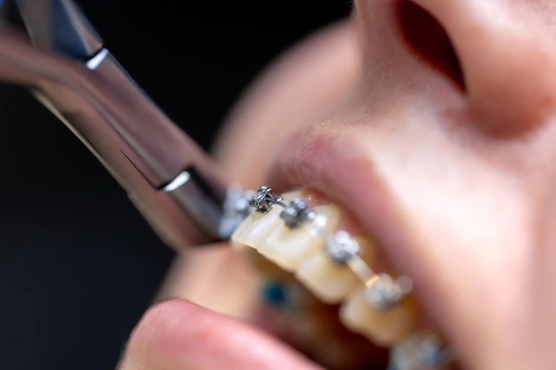 Вибір ортодонтичної системи: як лікар підбирає брекети під конкретний клінічний випадок